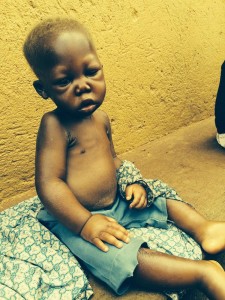 Baby Moses severely malnourished